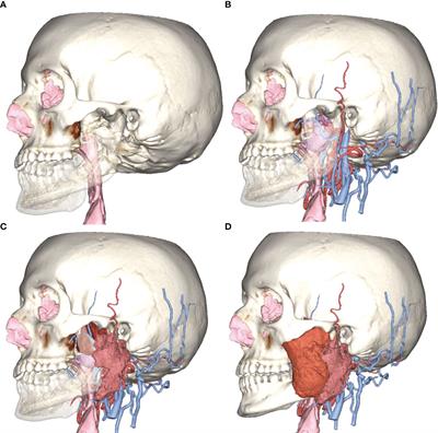 Anatomical Computerized Exploration to Excise Malignancies in Deep Facial Compartments: An Advanced Virtual Reality Protocol for a Tailored Surgical Approach